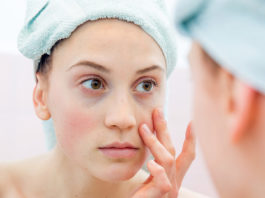 5 Ways to Deal With Dark Circles Before Your Wedding