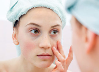 5 Ways to Deal With Dark Circles Before Your Wedding