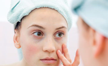 5 Ways to Deal With Dark Circles Before Your Wedding